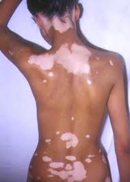 Vitiligo