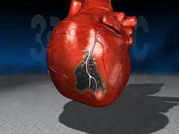 infarkt