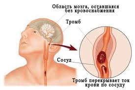 Инсульт